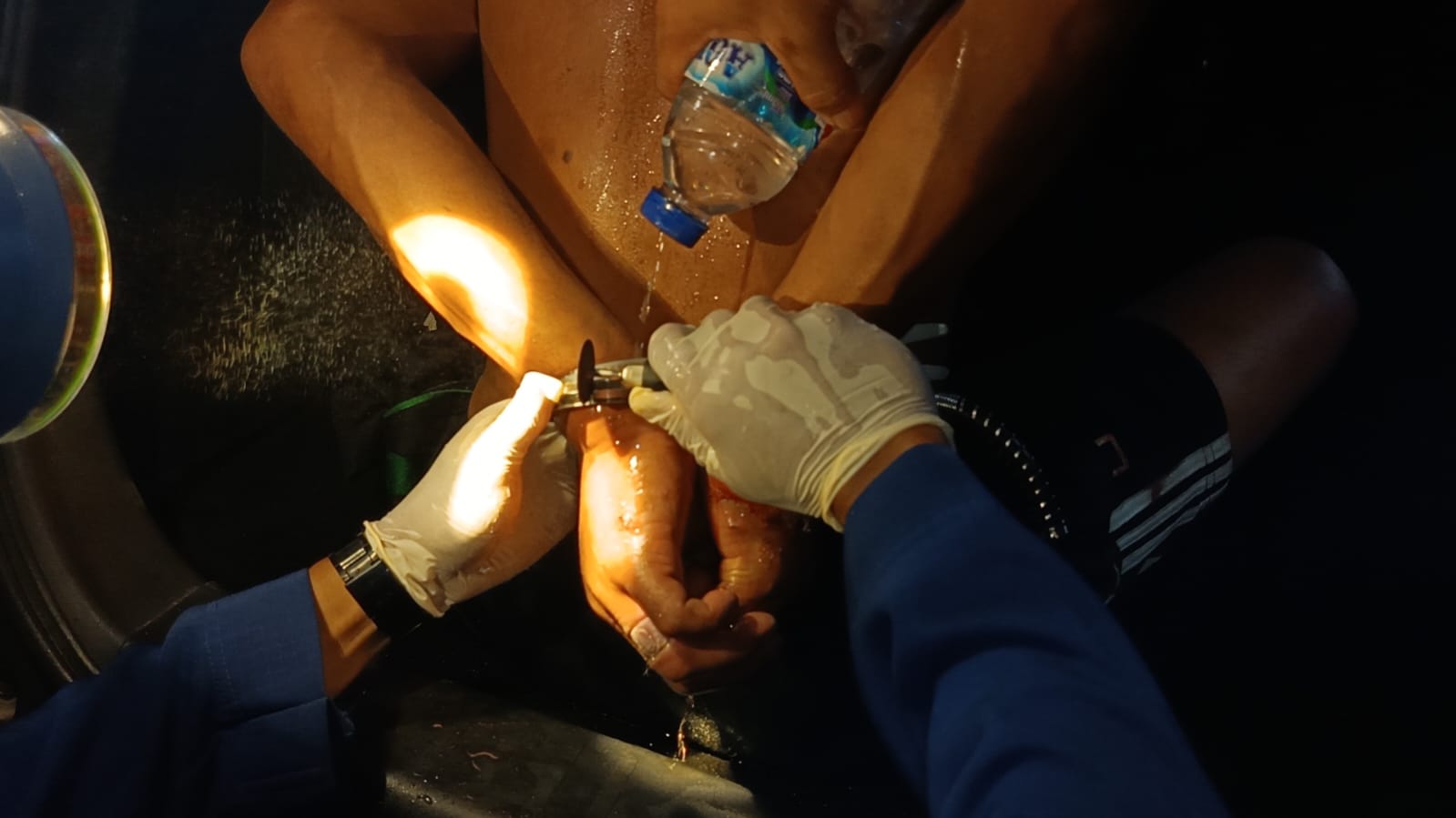Damkartan Kota Jambi Evakuasi Cincin dan Gelang Titanium dari Pasien ODGJ