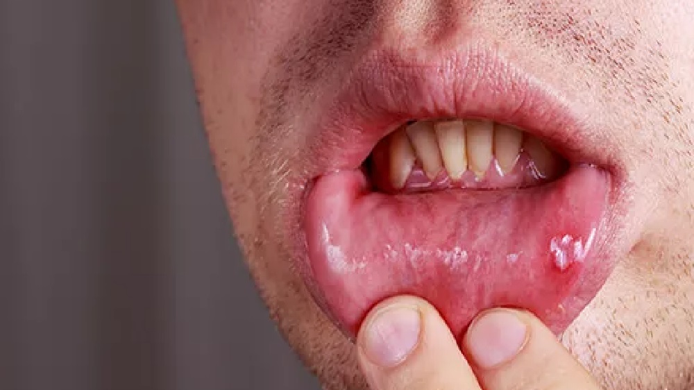 7 Penyakit Kronis yang Terjadi di Bagian Mulut, No 3 Bisa Kehilangan Gigi