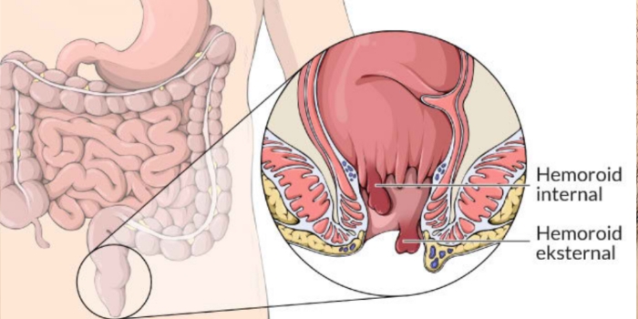 Wasir, Jangan Biarkan Mengganggu Aktivitas Anda