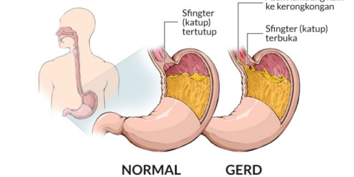 Penyakit Asam Lambung tidak boleh diremehkan begitu saja 