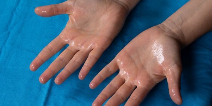 Hiperhidrosis Palmar: Penyebab Tangan Berkeringat Berlebihan