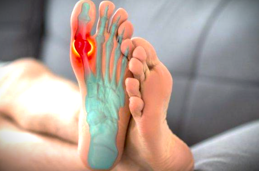 Kenali Gejala Asam Urat (Gout Arthritis) dan Cara Pencegahannya