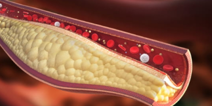 Bahaya Kolestrol dan Penyebabnya. 