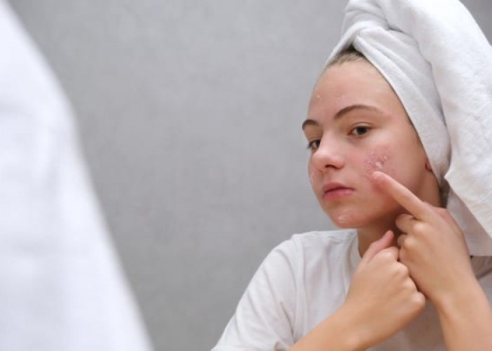 5 Kandungan Skincare yang Efektif Membantu Memudarkan Bekas Jerawat