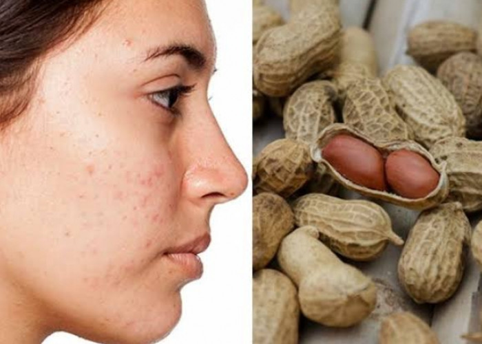 Benarkah Makan Kacang Dapat Memicu Timbulnya Jerawat? Ini Faktanya 
