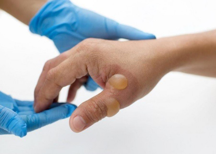 Luka Bakar Tersiram Air Panas Jangan Diolesi Odol, Lakukan Cara Ini Agar Luka Tak Semakin Parah