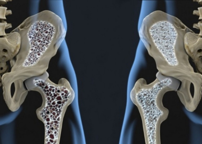 Osteoporosis: Penyakit Tulang Keropos yang Perlu Diwaspadai