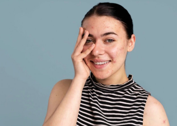 Jangan Dipencet! B ERL Very Berry Acne Spot Treatment Senjata Praktis Lawan Jerawat Membandel