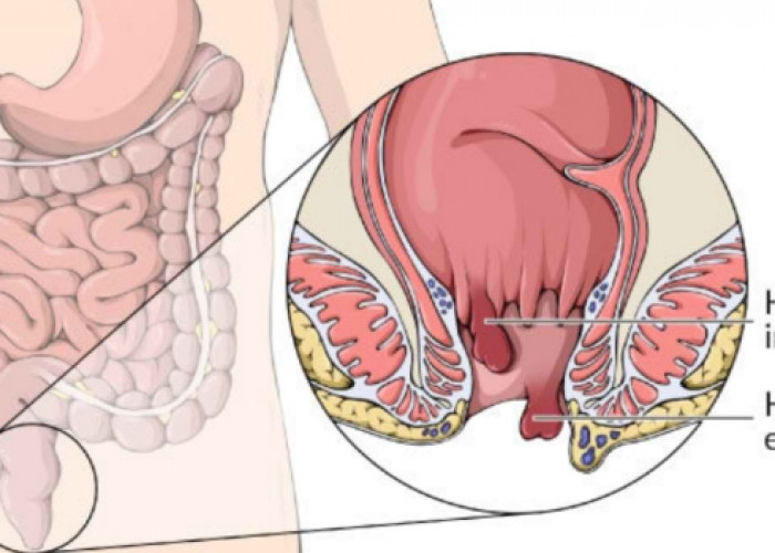 Wasir, Jangan Biarkan Mengganggu Aktivitas Anda