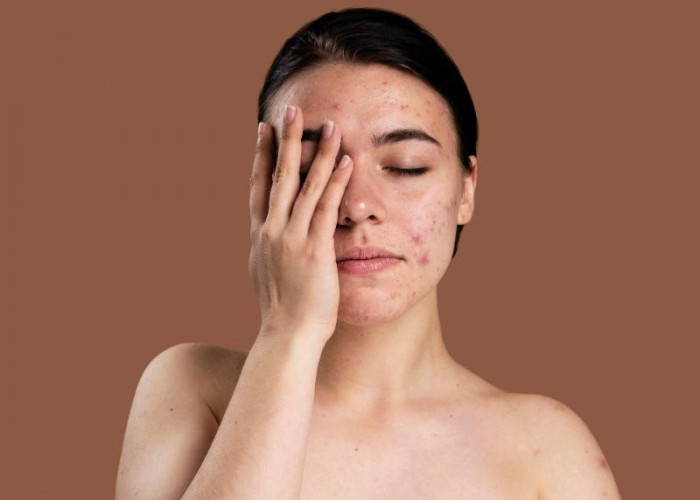 Brekout Tiba-Tiba Muncul? Ini Tips Efektif untuk Mengatasinya