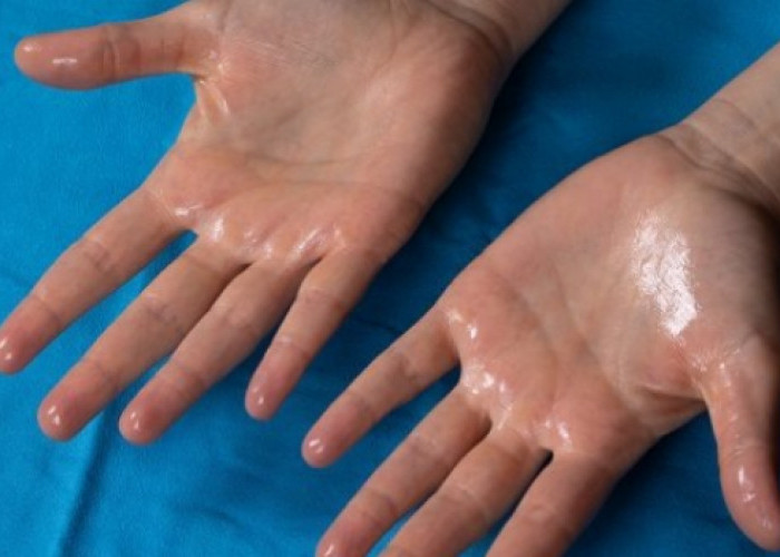 Hiperhidrosis Palmar: Penyebab Tangan Berkeringat Berlebihan