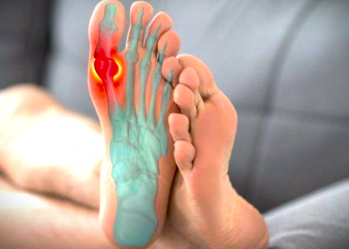 Kenali Gejala Asam Urat (Gout Arthritis) dan Cara Pencegahannya