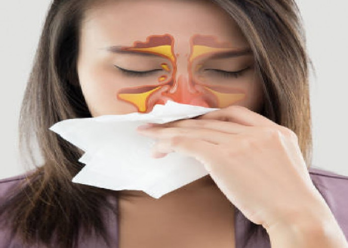 Ketahui Penyebab dan Pencegahan Radang pada Hidung (Sinusitis)
