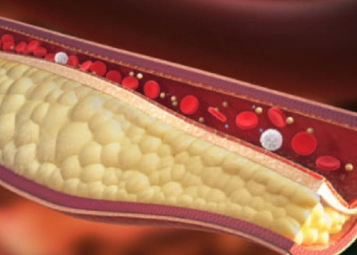Bahaya Kolestrol dan Penyebabnya. 