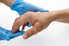 Luka Bakar Tersiram Air Panas Jangan Diolesi Odol, Lakukan Cara Ini Agar Luka Tak Semakin Parah