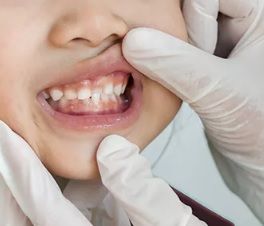 Studi Terbaru : Radang Gigi Dapat Menyebabkan Penyakit Jatung